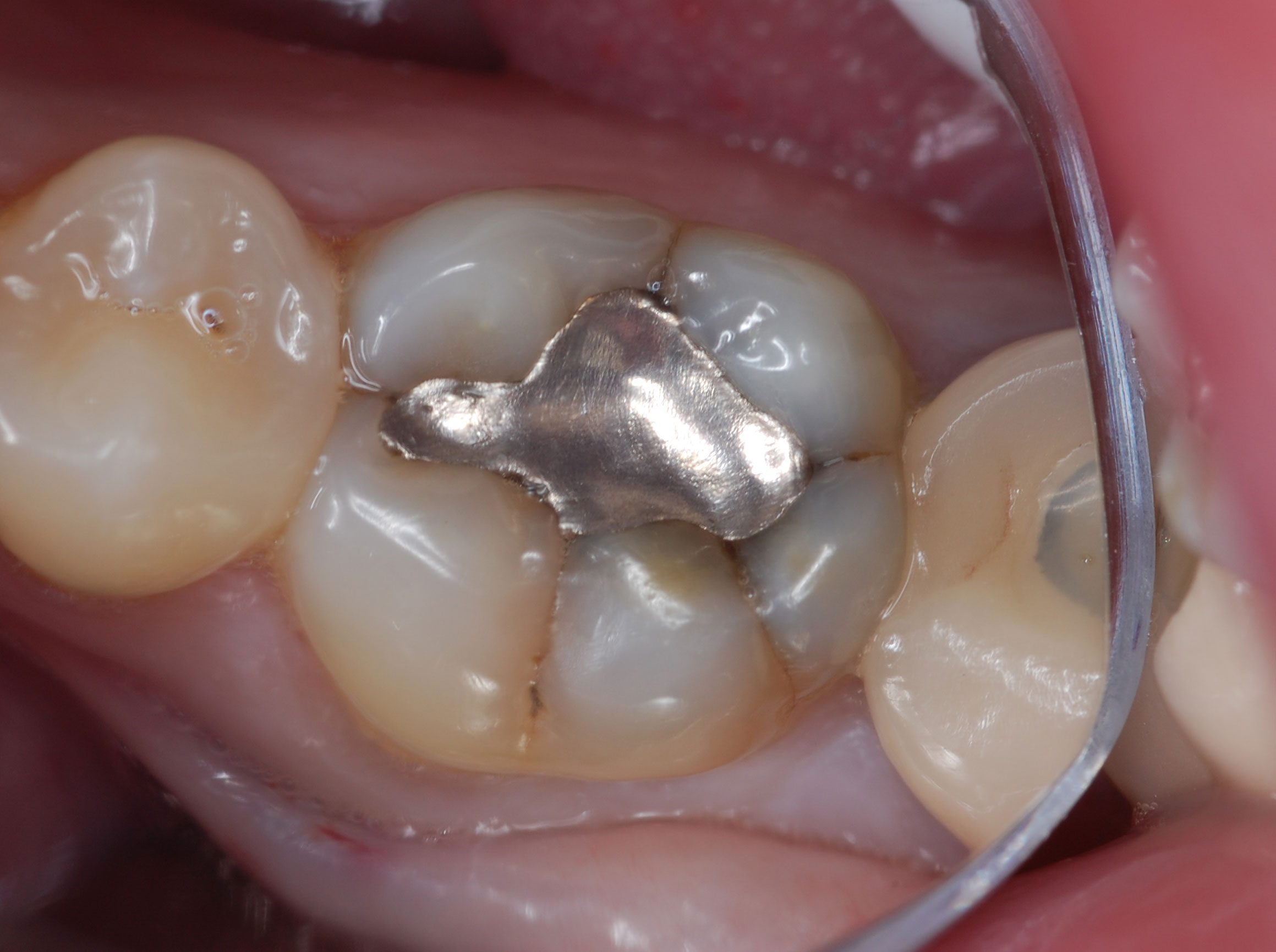 Amalgam Fillings Ibs At Wendell Espinoza Blog Amalgam Fillings Ibs At Wendell Espinoza Blog